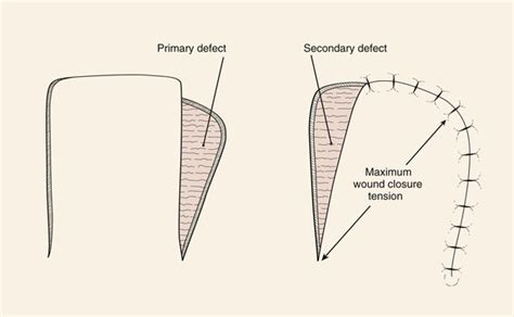 Flap Classification And Design Plastic Surgery Key