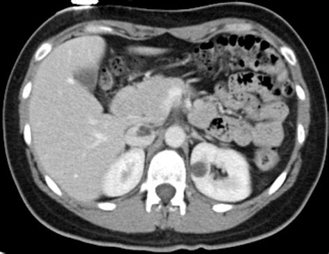 Sporadic Classic Type Renal Angiomyolipoma With Renal Vein And