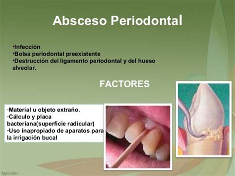 Patologia Absceso Periodontal