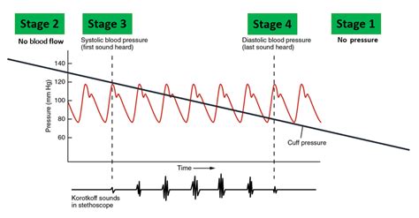 Auscultatory Method Measures Blood Pressure Based On Korotkoff Sounds