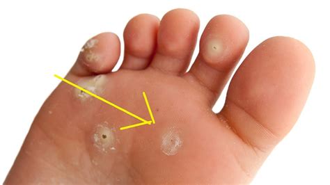 How To Get Rid Of Plantar Warts With Banana Peel Fast Youtube