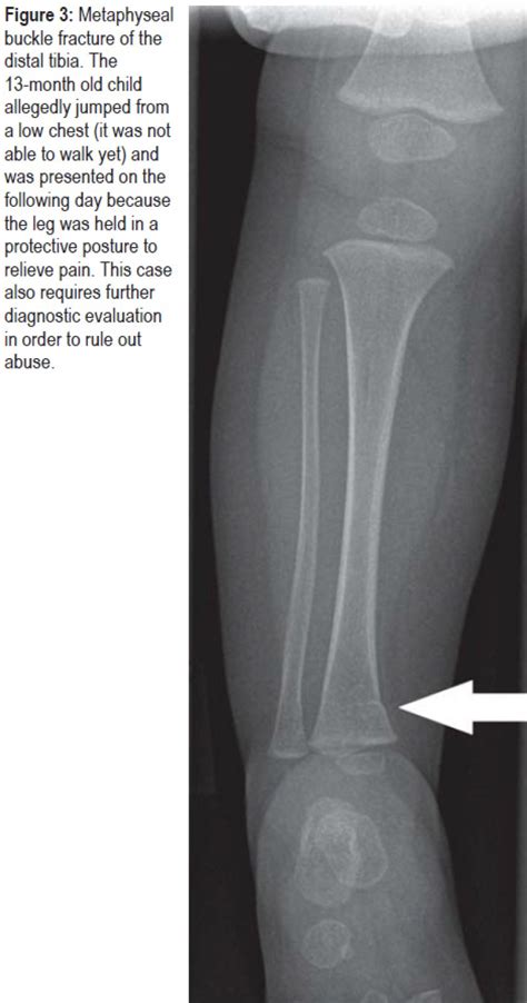 Tibial Metaphysis Fracture