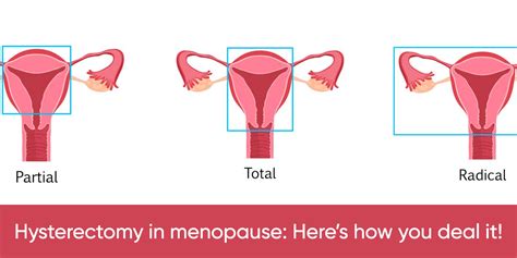 Hysterectomy In Menopause Here S How You Deal It