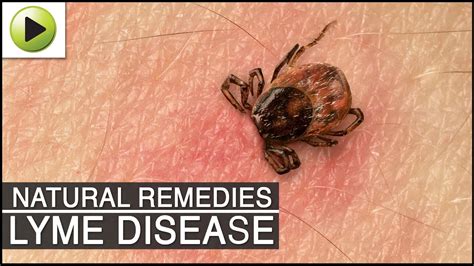 Lyme Disease Natural Ayurvedic Home Remedies Youtube