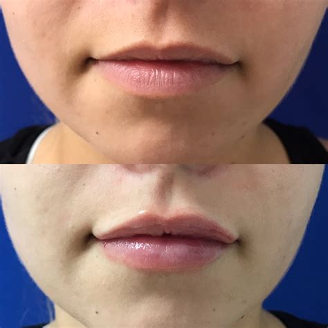 Juvéderm Volbella Xc Lip Fillers In Santa Rosa And Healdsburg