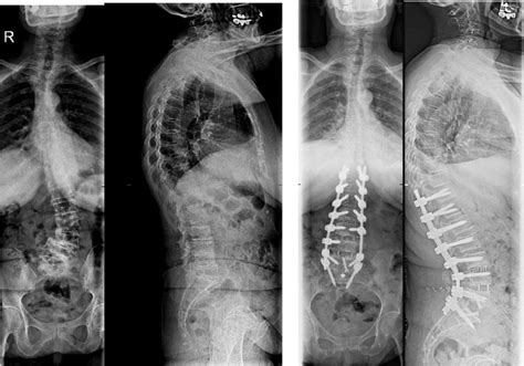 Lumbar Lordosis Correction With Interbody Hyperlordotic Cages Initial