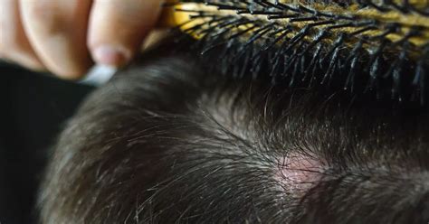 Blood Filled Cysts And Hair Loss Warning Issued Over Scalp Popping