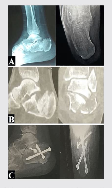 A 28 Year Old Male Patient With Sanders Type Iii Calcaneal Fracture