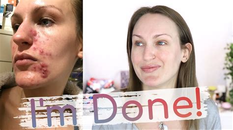 Isotretinoin Diaries Month 12 Achievement Unlocked Youtube