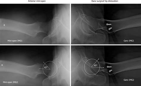 Femoroacetabular Impingement Fai Dominic Carreira Md