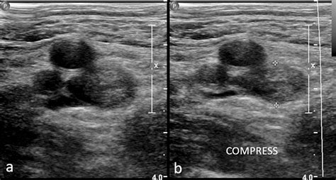 Lower Extremity Venous Ultrasound In Dvt Unlikely Patients With