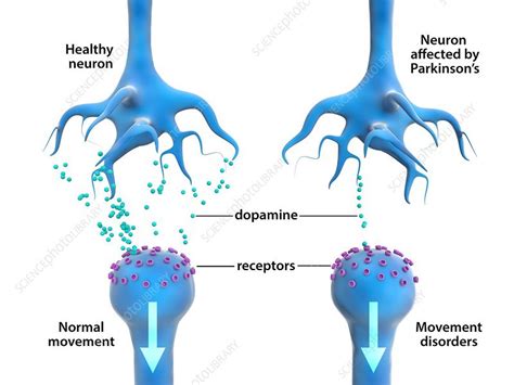 Is Parkinsons Disease A Motor Neuron Disease