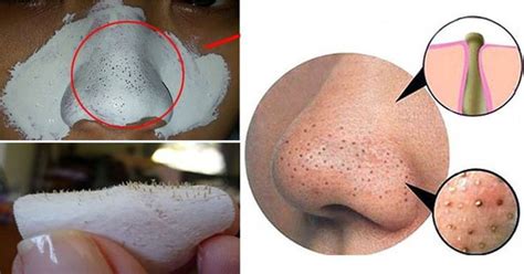 7 Best Home Remedies To Remove Tons Of Blackheads On Face And Nose