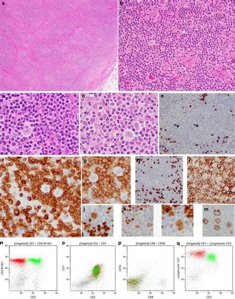 Peripheral T Cell Lymphomas Of Follicular Helper T Cell Type Frequently