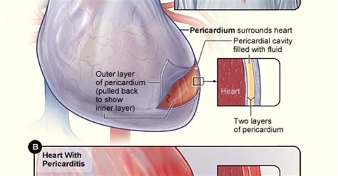 Pericarditis is defined as inflammation of the pericardium. Pericarditis aguda en niños | Faros HSJBCN