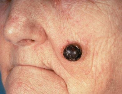 Most people associate lung cancer with smoking, but that doesn't paint the whole picture, says david ross camidge, m.d., ph.d., professor of medical oncology and lung. Melanomas Aren't the Only Dangerous Skin Cancers - Healthy ...