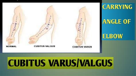 Cubitus Varus In Hindicubitus Valgus In Hindicarrying Angle Of Elbow