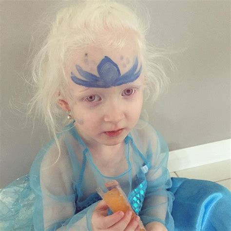 Elsa Gives Confidence To Queensland Girl With Albinism Daily Mail Online