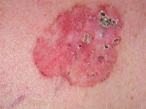 Basal Cell Carcinoma Dry Red Patch That Doesnt Heal Fair Skin Is A