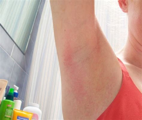 Underarm Rash Pictures Treatment Symptoms Causes