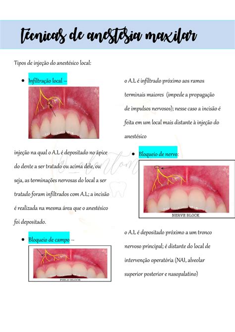 Tecnicas De Anestesia Maxilar Tipos De Injeção Do Anestésico Local