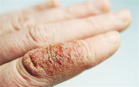 Antibiotic Guidance Issued For Infected Eczema Mims Online