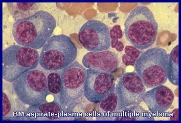 multiple myeloma  hematologist understand hematology