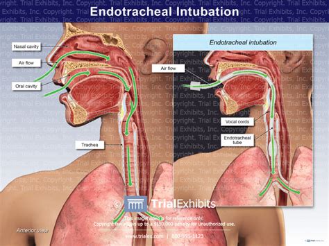 Endotracheal Intubation Trialexhibits Inc