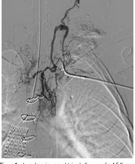 Figure 1 From Retrograde Thoracic Duct Embolization In A Pediatric