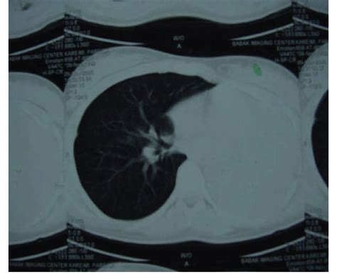 Ct Scan Shows The Complete Collapse Of Left Lung Download Scientific