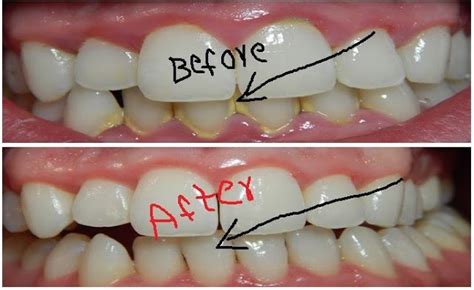 Plaque accumulation for more extended time leads to the formation of more lemony. How To Remove Dental Plaque In 5 Minutes Naturally ...