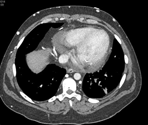 Svc Syndrome With Multiple Collaterals In Chest Wall And Abdomen