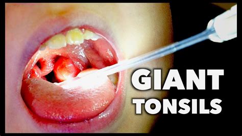 Giant Tonsils Strep Throat Dr Paul Youtube