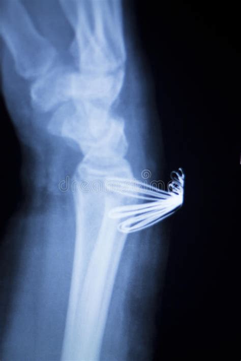 Forearm Orthopedic Implant Xray Scan Stock Image Image Of Scan