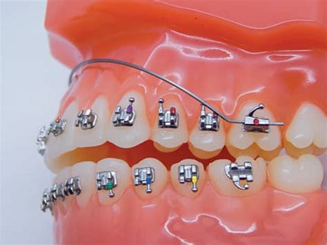 Gandh Orthodontics Introduces Titanmoly Archwires Orthodontic Products
