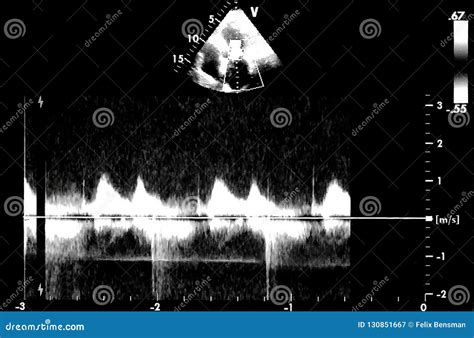 Cardiac Ultrasound Images Doppler Echo Stock Image Image Of Artery