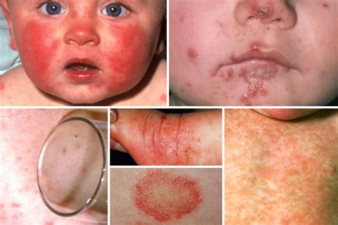 From Meningitis To Eczema And Ringworm We Reveal What Your Babys Rash