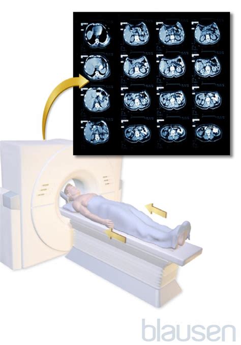 Quick Facts: Computed Tomography - MSD Manual Consumer Version