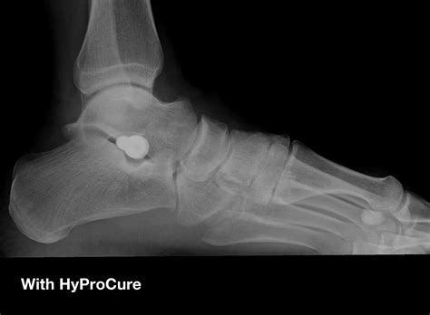 Hyprocure Surgery In Lake Charles La Louisiana Foot And Ankle Specialists