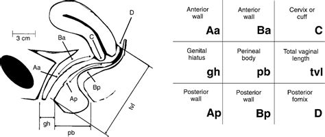 practice bulletin no pelvic organ prolapse obstetrics gynecology hot sex picture