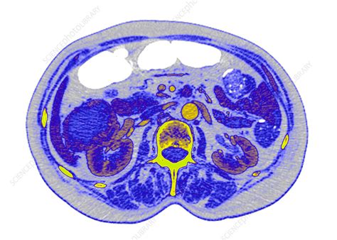 Kidney Cancer Ct Scan Stock Image C0267599 Science Photo Library