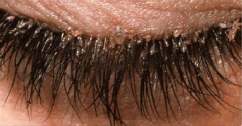 What Are Eyelash Mites Woman Suffers Redness In Eyes Due To Parasites
