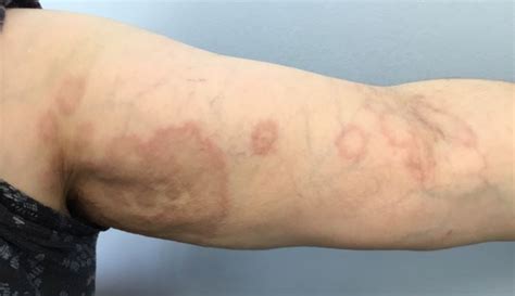 Clinical Challenge Round Red Spreading Rash Mpr