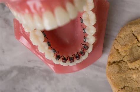 Lingual Braces The Hidden Secret To A Beautiful Smile