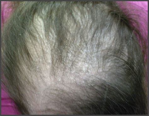 Psoriasis And Hair Loss Pictures Psoriasis Expert