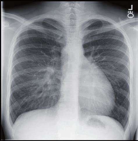 Chest Radiograph In Dtha Showing Egg On String Appearance Download