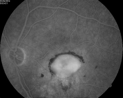 Cnv Due To Chronic Central Serous Retinopathy Retina Image Bank