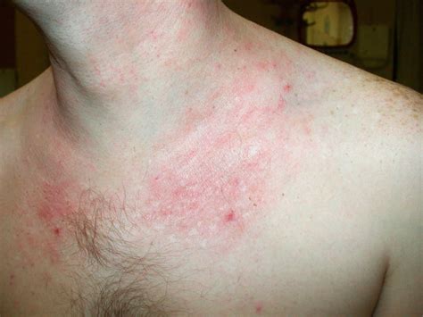 What Does Atopic Dermatitis Look Like