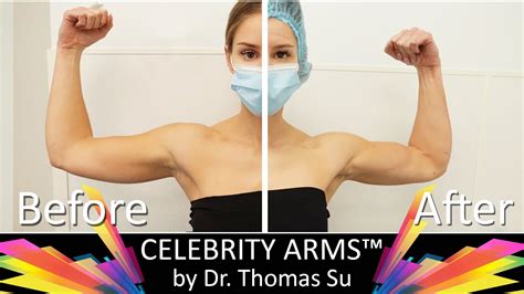Celebrity Arms Lipo Arms Arm Liposuction Immediate Results