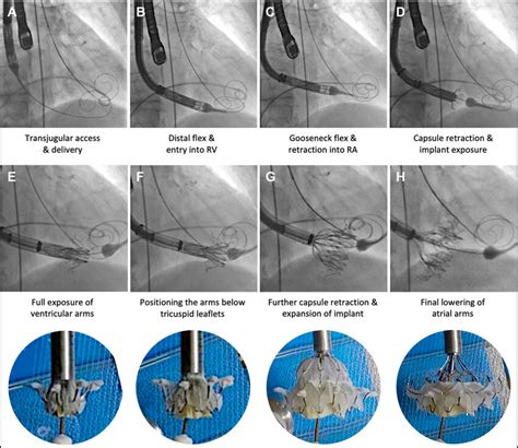 Transcatheter Tricuspid Valve Replacement By Transjugular Approach